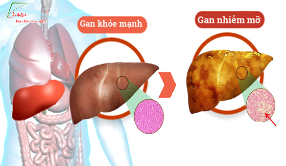 Chữa gan nhiễm mỡ và gan nhiễm máu bằng lá sen khô